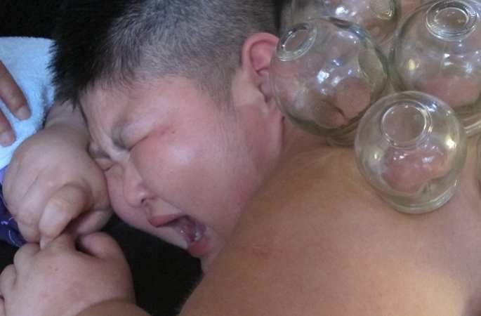 하얼빈 9세 남아 143kg, 비만으로 학교도 못 가